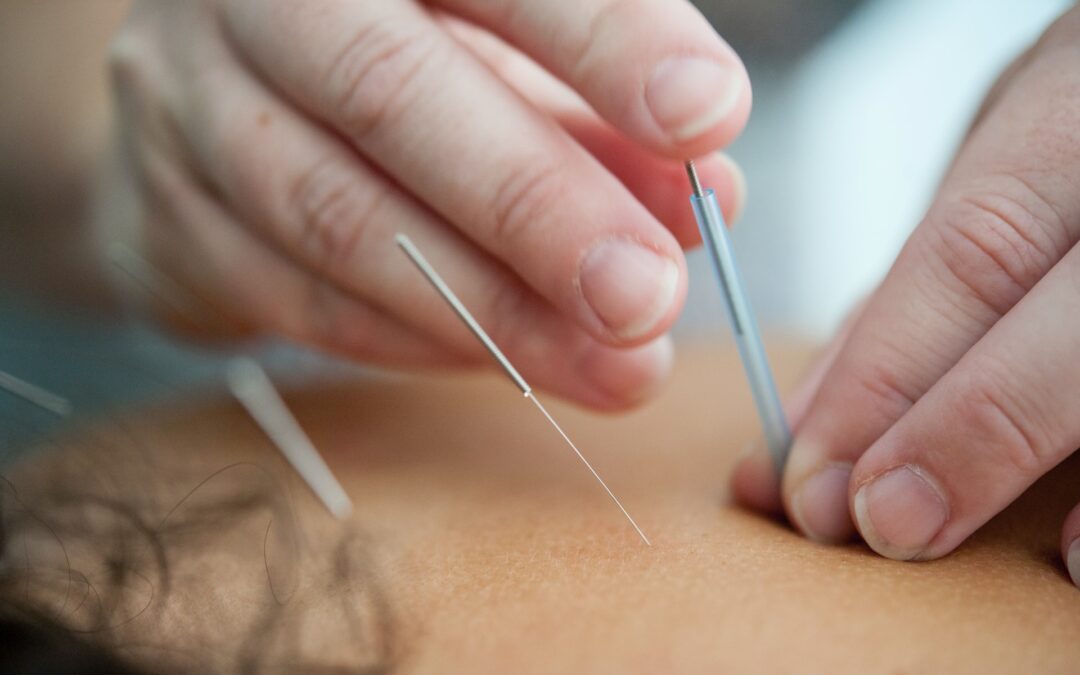 Acupuncture in Perth, West Perth