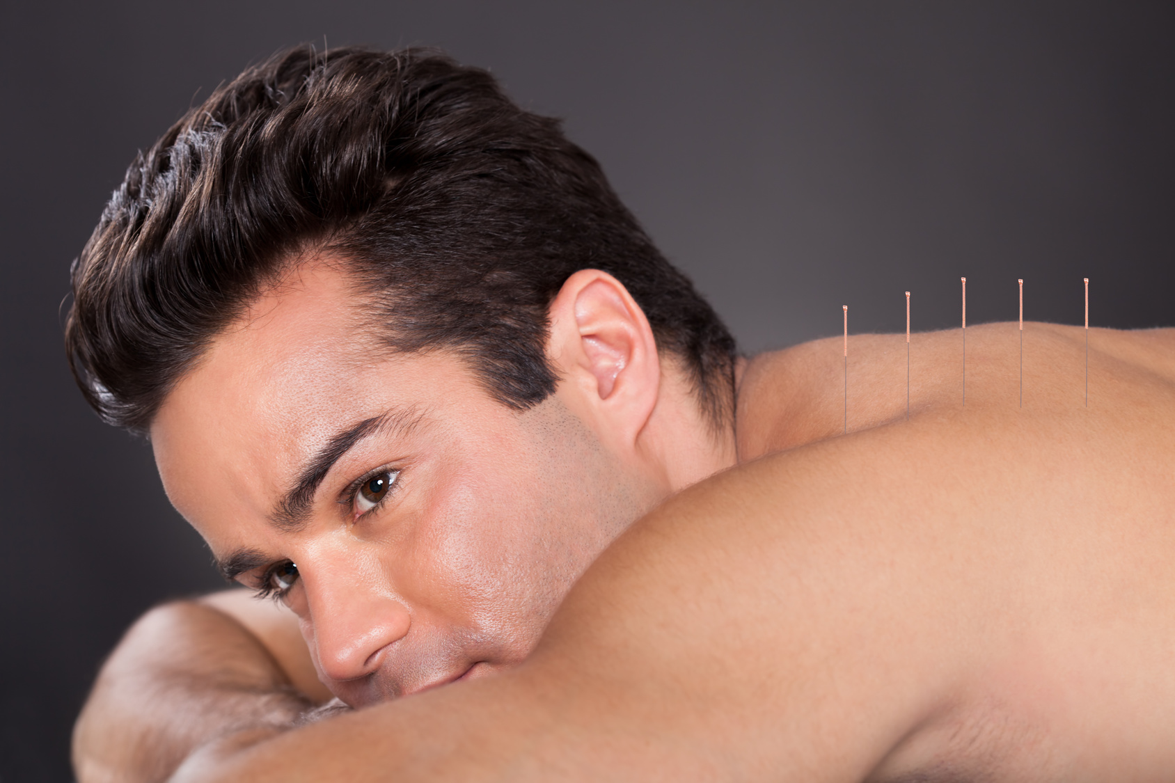 Close-up Of A Young Man Getting Acupuncture Treatment At Spa