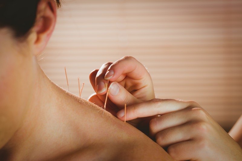 Acupuncture clinic in Spearwood, Bibra lake, Hamilton Hill